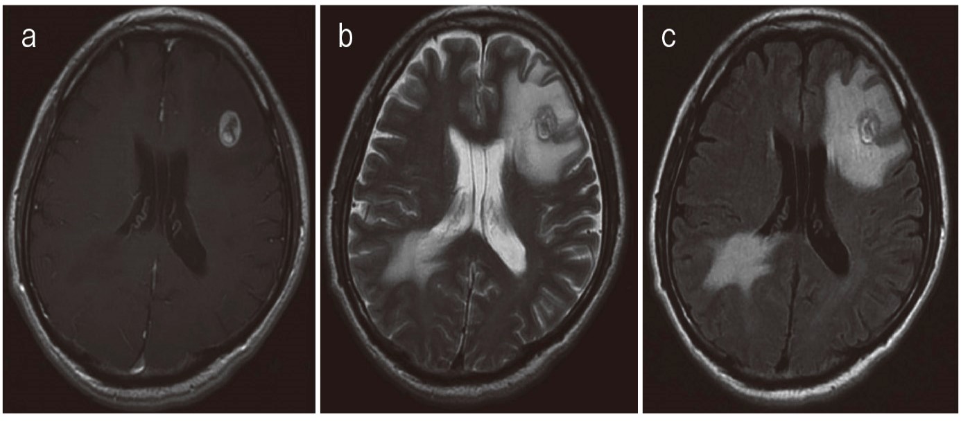 脳腫瘍の見通し